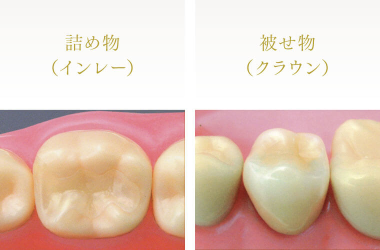 詰め物（インレー）　被せ物（クラウン）