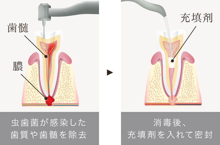 虫歯菌が感染した歯質や歯髄を除去。消毒後、充填剤を入れて密封