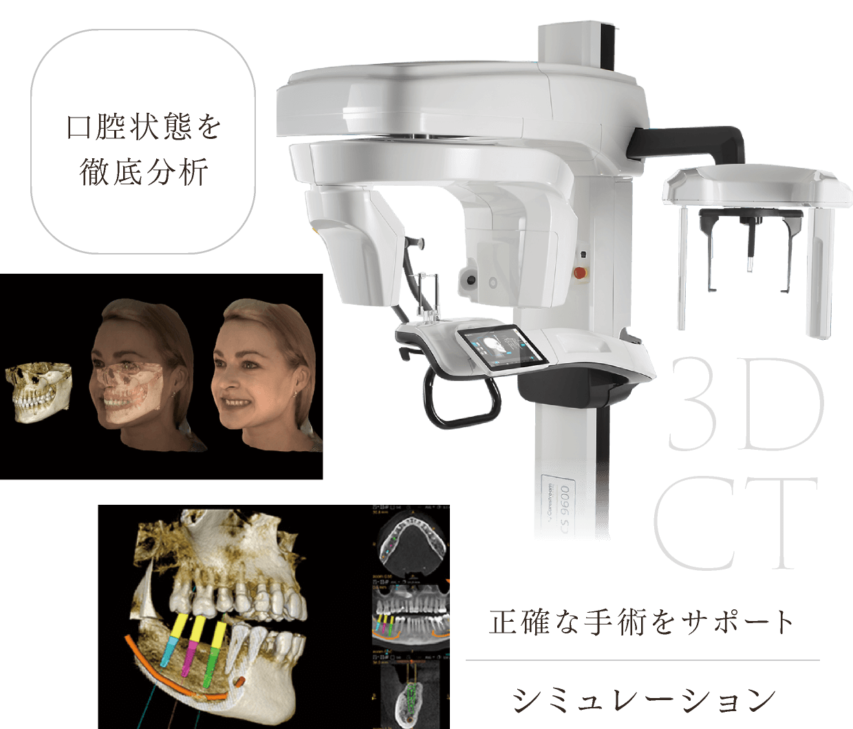 3DCT 口腔状態を徹底分析 正確な手術をサポート　シミュレーション