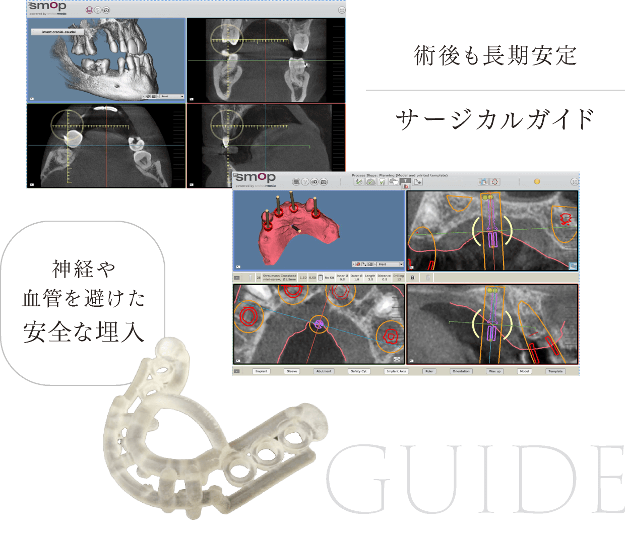 術後も長期安定 サージカルガイド 神経や血管を避けた安全な埋入