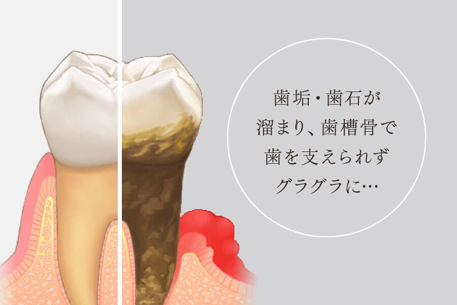歯垢・歯石が溜まり、歯槽骨で歯を支えられずグラグラに…